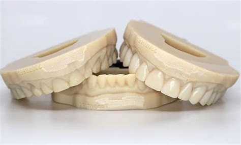 IDeaL Smile Design Diagnostic Wax Ups Iverson Dental Labs