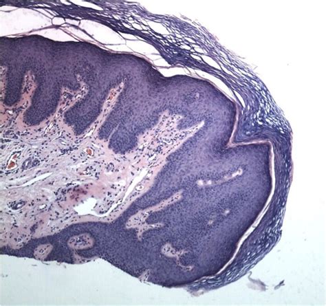 Condyloma Acuminatum Genital Warts Dermatology Advisor