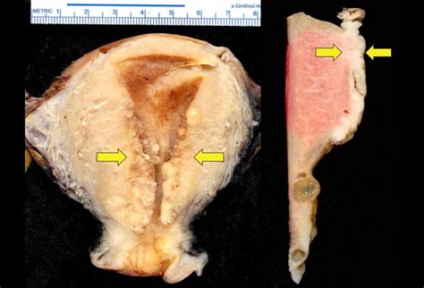 Endometrial Cancer Common But Predominantly Curable