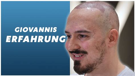 Haartransplantation Türkei l Giovannis Erfahrung mit Cosmedica Dr