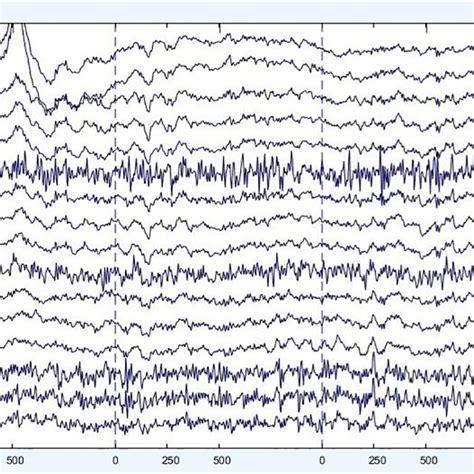 Example Of Recorded Electroencephalography Eeg Signals With Eye Blink