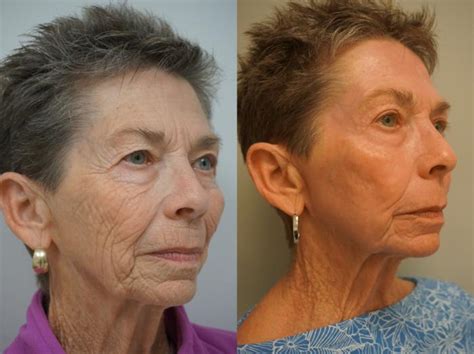 Renuvion J Plasma Skin Tightening Before After Photo Gallery