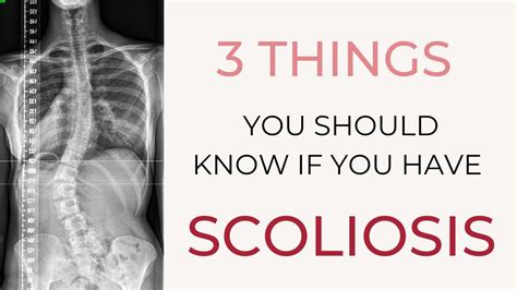 Scoliosis Tips 3 Things You Should Know If You Have Scoliosis Youtube