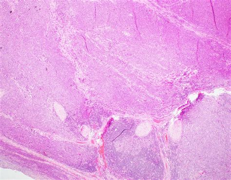 Poorly differentiated squamous cell carcinoma of the larynx with ...