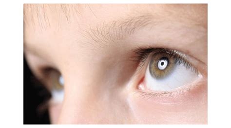 What Are the Causes of Nystagmus, Diagnoses, Treatments | OBN