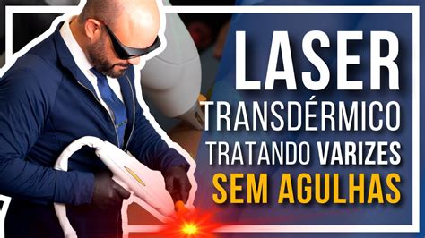 LASER TRANSDÉRMICO Tratamento de varizes e vasinhos sem agulhas