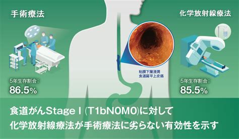 臨床病期i期食道扁平上皮がんにおける標準治療を検証 化学放射線療法が手術療法に劣らない有効性を示し、 新たな治療選択肢に 国立がん研究