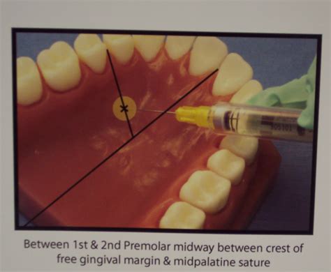 Maxillary Injections Flashcards Quizlet