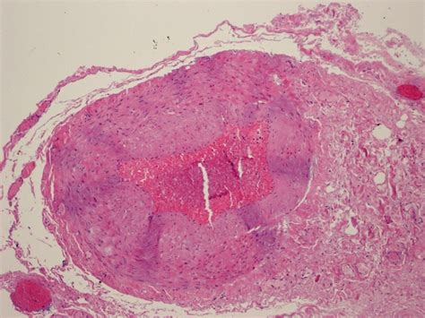 Moran Core Optic Nerve