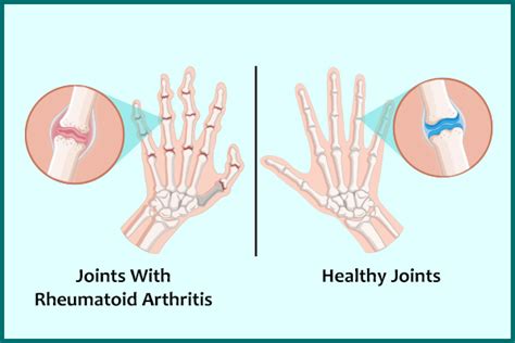 Rheumatoid Arthritis The 4 Stages Signs And Treatment