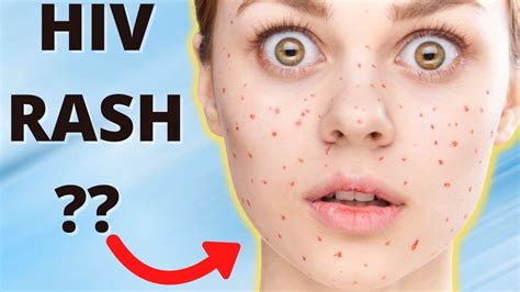 Hiv Rash On Face How To Identify An Hiv Rash Youtube