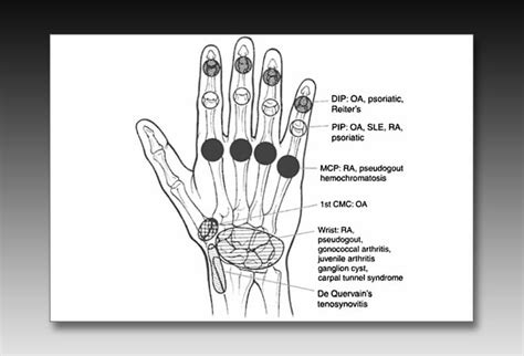 Notable Knuckles, Part 2: Evaluating More Conditions of the Hand