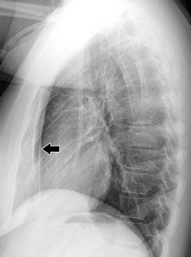 Broken Sternum X Ray