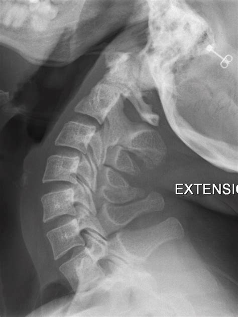 Normal flexion and extension cervical spine x-rays | Radiology Case | Radiopaedia.org Create ...