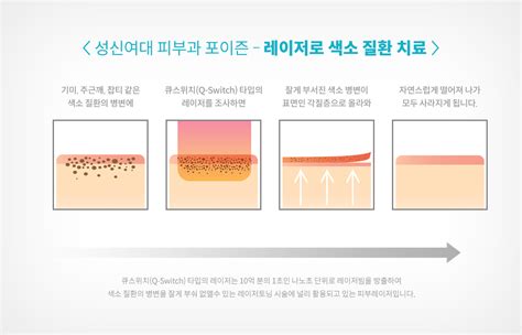 ﻿성북동 피부과 강력한 레이저토닝으로 난치성 피부질환인 기미를 치료 성신여대 포이즌 피부칼럼 성신여대피부과 포이즌의원