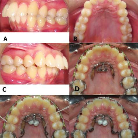 A To C Pretreatment Intraoral Photographs Of A 23 Year Old Patient