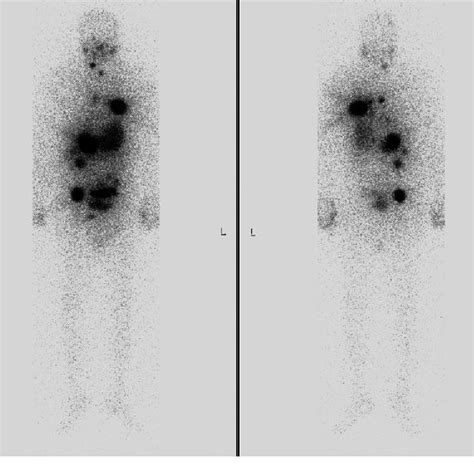 Iodine Uptake Scan Showing Visceral Metastasis Download Scientific