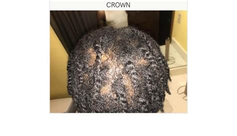 Finasteride results so far : r/HairlossProgressPics