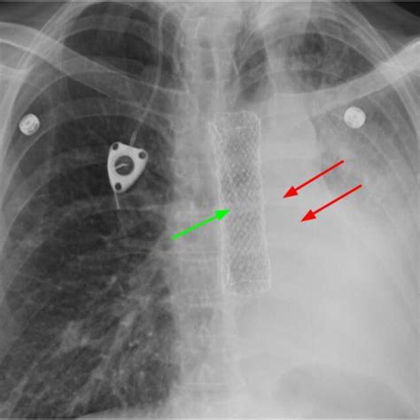 Pa Chest Radiograph Shows The Esophageal Stent Green Arrow And Download Scientific Diagram