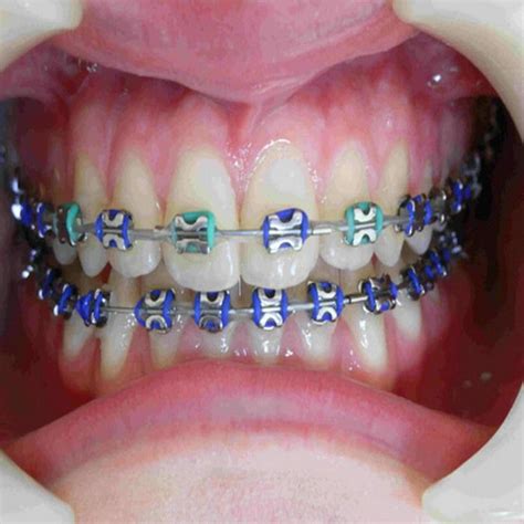 97 best Colors Braces images on Pinterest