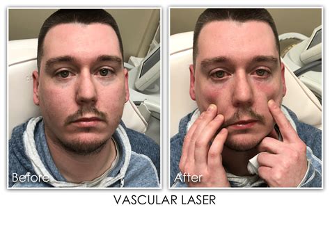 Laser And Light For Men Archives Skin Rejuvenation Clinic Skin