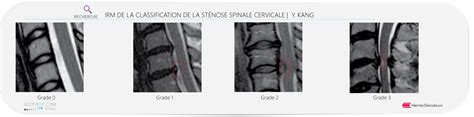 St Nose Spinale Cervicale Sympt Mes C C C C Hot Sex Picture