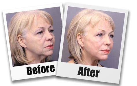 Facelift Seattle Best Facial Surgeon Dr Santos In Seattle