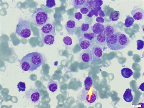 Bone Marrow Aspiration Smear Showing Diffuse Plasma Cell Infiltration