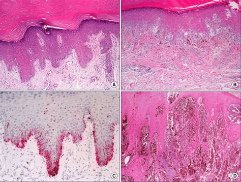 Melanoma In Situ Histology