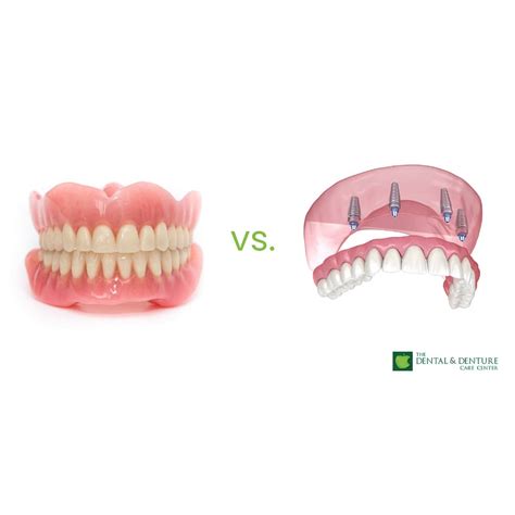 Snap In Dentures Vs Regular Dentures The Dental And Denture Care Center