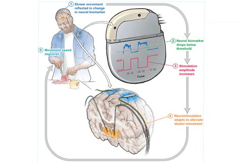 Real Time Brain Stimulation Slashes Parkinson S Symptoms By Half In