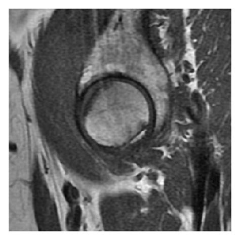 (a) X-ray of a patient with transient osteoporosis of the left hip ...