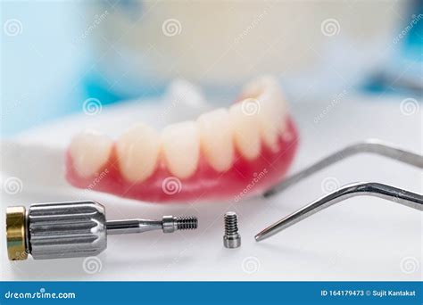 Dental Implants Supported Overdenture. Stock Image - Image of care ...