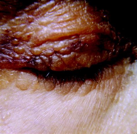 Cutaneous Manifestations Of Internal Malignancy Thiers 2009 Ca A Cancer Journal For