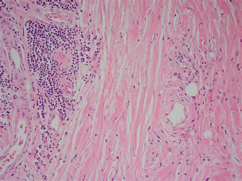 Pathology Outlines Sclerosing Mesenteritis