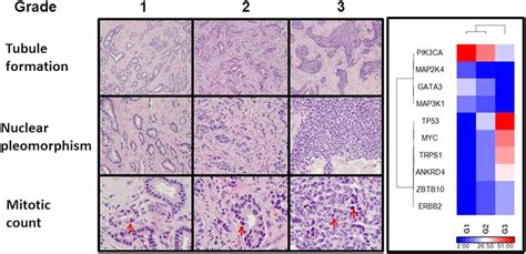 Invasive Ductal Carcinoma Histology