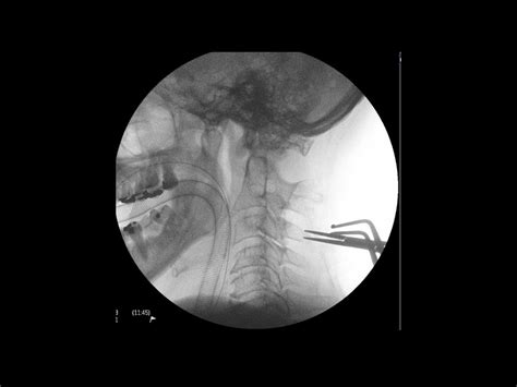 Cervical Spine Decompression Posterior Approach Degenerative Cervical