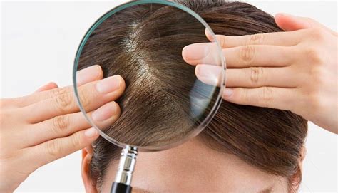 Cara Menghilangkan Kutu Di Rambut Secara Cepat Menghilangkan Masalah