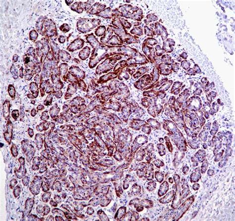 Sclerosing Adenosis Core Biopsy Bosnianpathology