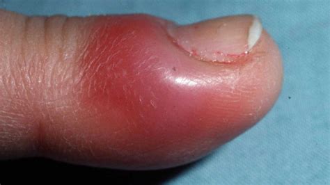 Finger Infection