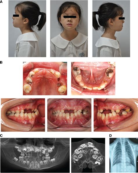 Cleidocranial Dysplasia