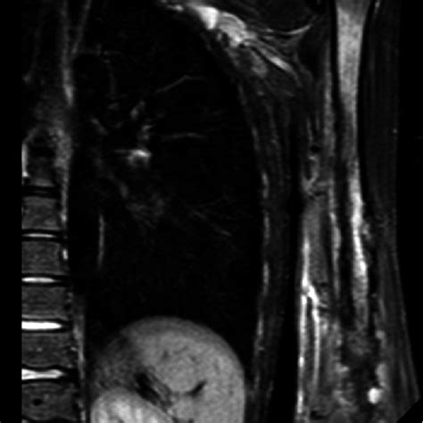 X-ray left humerus | Download High-Resolution Scientific Diagram