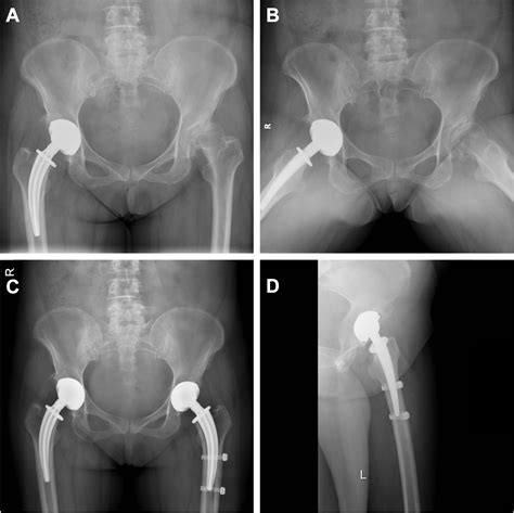 Incidence Classification And Risk Factors For Intraoperative Periprosthetic Femoral Fractures