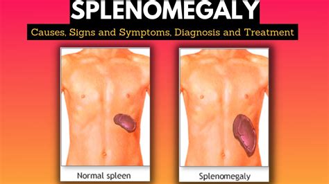 Splenomegaly Causes Signs And Symptoms Diagnosis And Treatment Youtube