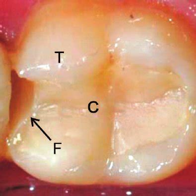 Standardized Preparation Designs And Composite Restorations C With