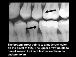 radiographic-caries-diagnosis | PPT