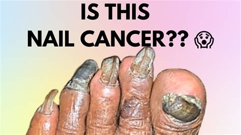 Skin Cancer Under Toenail