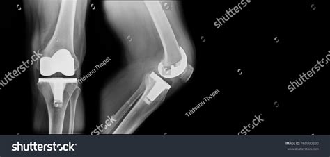 1,306 Old Knee X Ray Images, Stock Photos & Vectors | Shutterstock