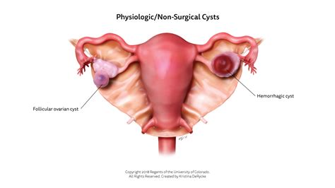 Cyst Thedentech