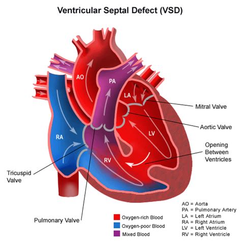 Ventricular Septal Defect Vsd